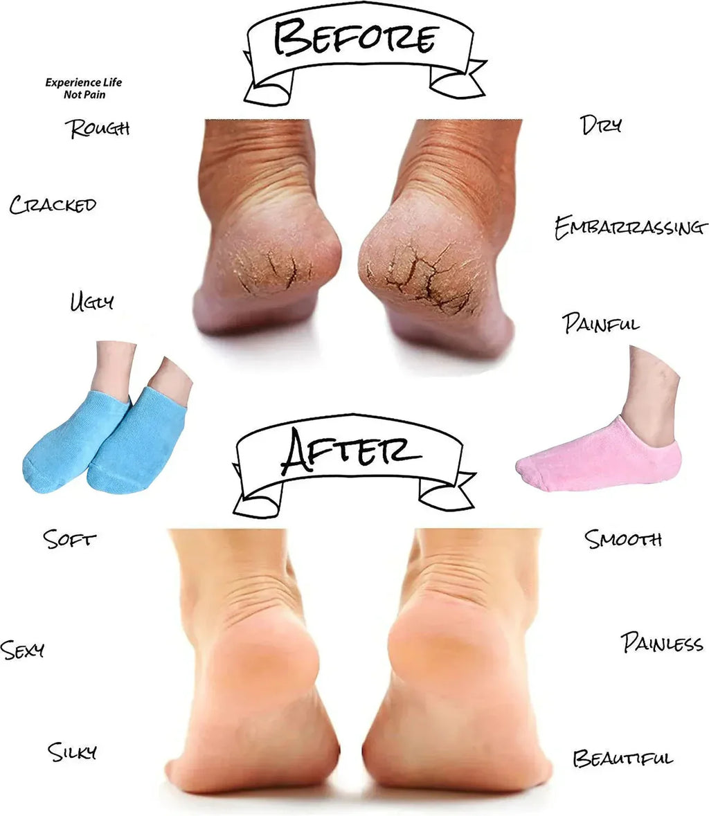 Moisturizing Socks - Silicone Socks for Dry Cracked Feet Women