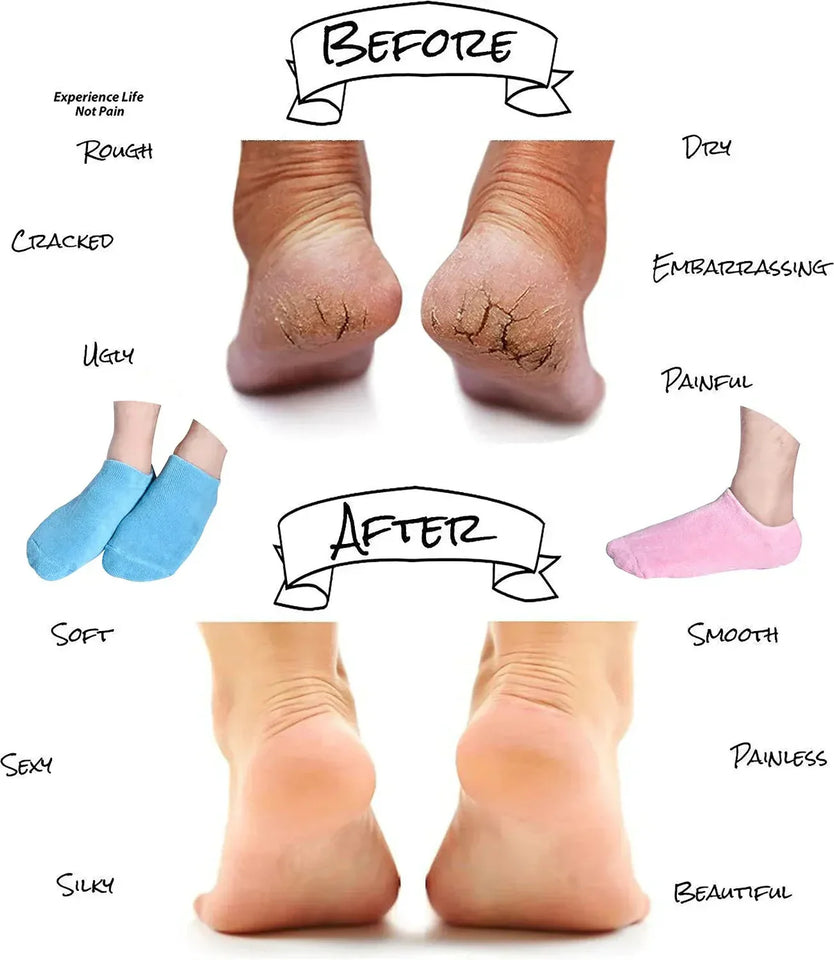 Moisturizing Socks - Silicone Socks for Dry Cracked Feet Women